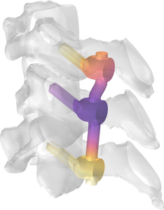 RF Implant Heating in MRI