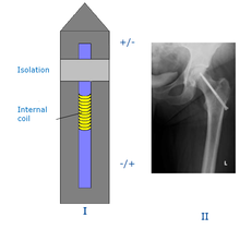 Electro-Stimulating Implants for Bone Regeneration: Parameter Analysis on ...
