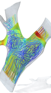 Utilizing COMSOL® in a Workflow to Asses Stroke Risks in a Large Set of ...