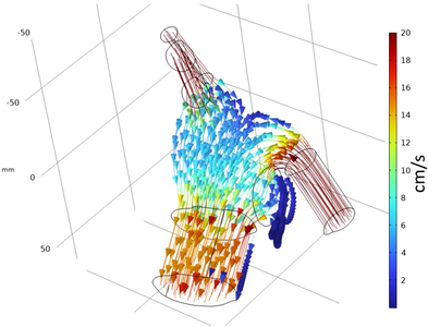 Simulations of Blood Flow in the Left Atrial Appendage: Investigating ...