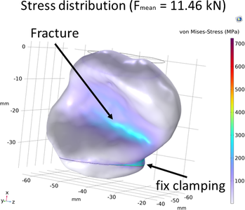 3-D Modeling of Stresses and Strains in Accessory Carpal Bone Under Maximum ...