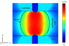 Computational Modeling to Study the Treatment of Cardiac Arrhythmias using ...