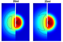 Effects Of Saline Infusion On The Lesion Size During The Radiofrequency ...