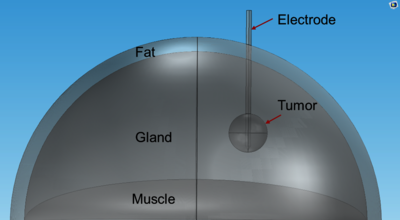 Modeling Radiofrequency Ablation of a Spherical Breast Tumor