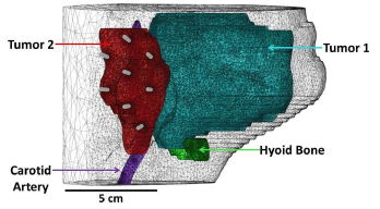 Simulating Light Propagation during I-PDT of Locally Advanced Head and Neck ...