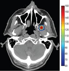 Virtual Thermal Ablation in the Head and Neck using COMSOL Multiphysics
