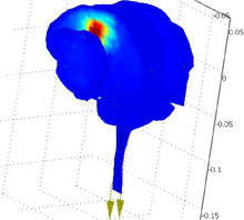 3-D Finite Element Modeling of Brain Edema: Initial Studies on Intracranial ...