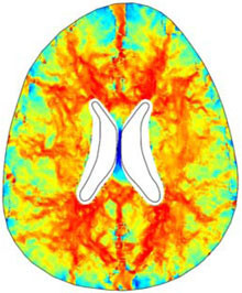 Biosimulation of Normal Pressure Hydrocephalus Using COMSOL Multiphysics ...