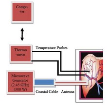 Microwave Interstitial Tumor Ablation: New Modality for Treatment of Liver ...