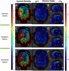 Finite Element Analysis of TTFields in Brain Metastasis According to ...