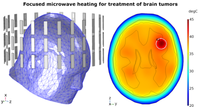 Treating Brain Cancer with Heat Therapy Using a Novel Noninvasive Microwave ...