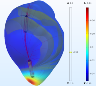 Investigating Intrabody Communication for Leadless Cardiac Pacemakers